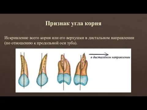 Признак угла корня Искривление всего корня или его верхушки в