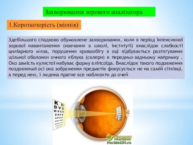 Здебільшого спадково обумовлене захворювання, коли в період інтенсивної зорової навантаження