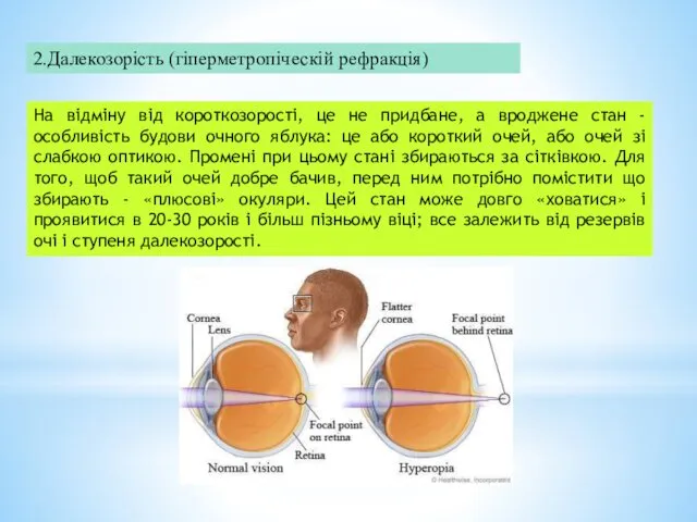 2.Далекозорість (гіперметропіческій рефракція) На відміну від короткозорості, це не придбане,