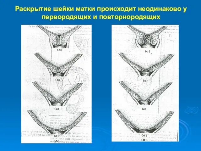 Раскрытие шейки матки происходит неодинаково у первородящих и повторнородящих