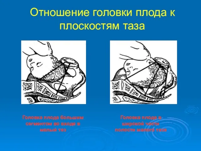 Отношение головки плода к плоскостям таза Головка плода большим сегментом