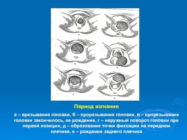 Период изгнания а – врезывание головки, б – прорезывание головки,