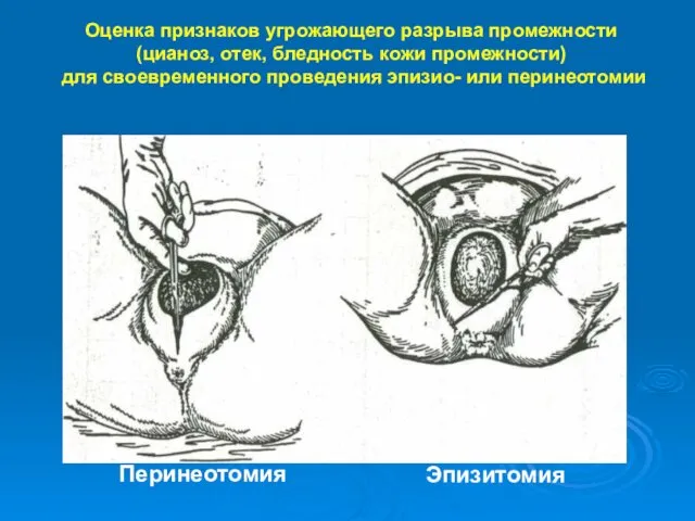 Оценка признаков угрожающего разрыва промежности (цианоз, отек, бледность кожи промежности)