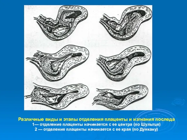 Различные виды и этапы отделения плаценты и изгнания последа 1—