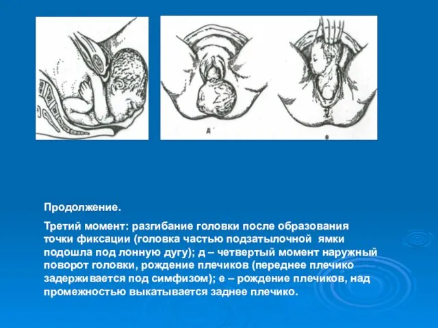 Продолжение. Третий момент: разгибание головки после образования точки фиксации (головка