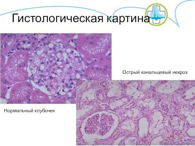 Гистологическая картина Нормальный клубочек Острый канальцевый некроз