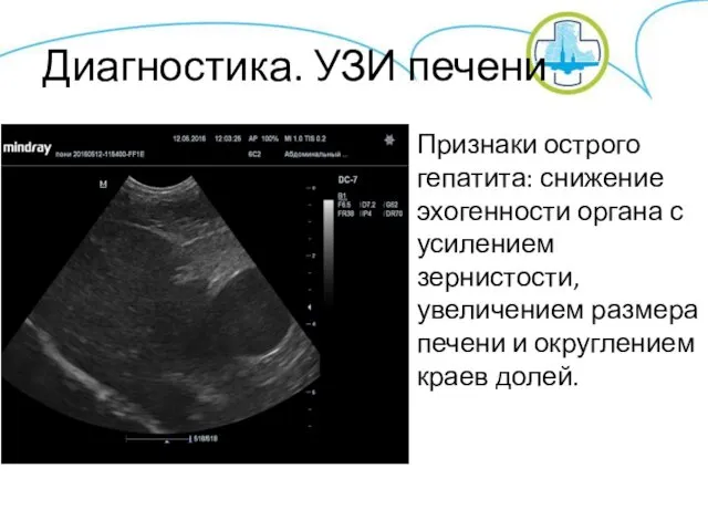 Диагностика. УЗИ печени Признаки острого гепатита: снижение эхогенности органа с