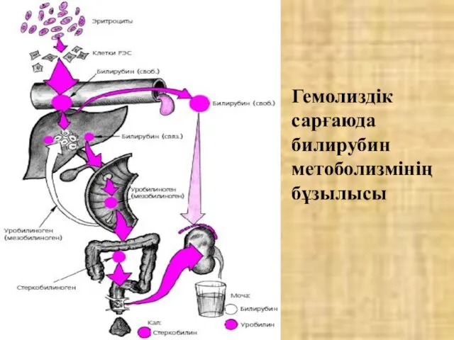 Гемолиздік сарғаюда билирубин метоболизмінің бұзылысы