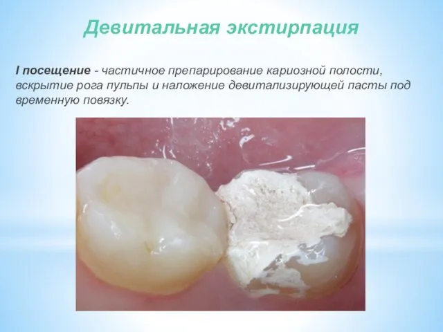 Девитальная экстирпация I посещение - частичное препарирование кариозной полости, вскрытие