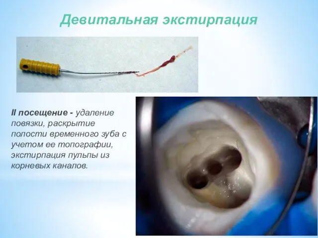 Девитальная экстирпация II посещение - удаление повязки, раскрытие полости временного