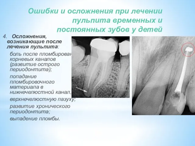 Ошибки и осложнения при лечении пульпита временных и постоянных зубов