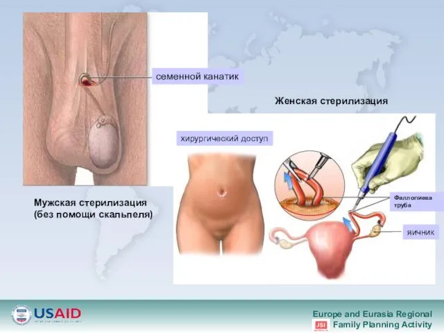 Мужская стерилизация (без помощи скальпеля) Женская стерилизация