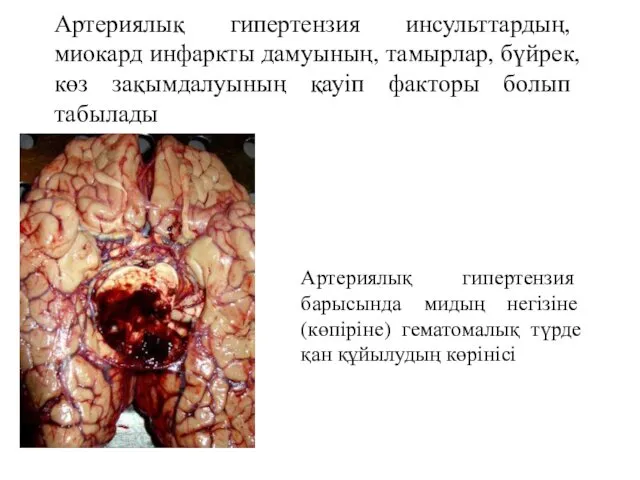 Артериялық гипертензия инсульттардың, миокард инфаркты дамуының, тамырлар, бүйрек, көз зақымдалуының