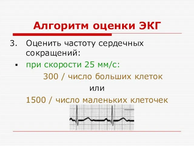 Алгоритм оценки ЭКГ Оценить частоту сердечных сокращений: при скорости 25 мм/с: 300 /