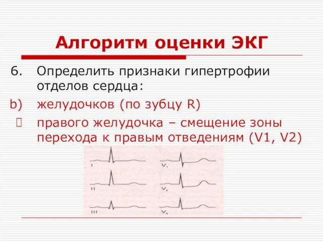 Алгоритм оценки ЭКГ Определить признаки гипертрофии отделов сердца: желудочков (по зубцу R) правого