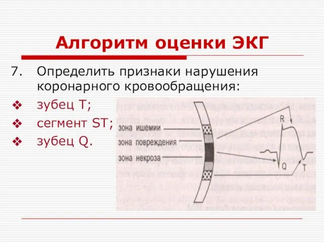 Алгоритм оценки ЭКГ Определить признаки нарушения коронарного кровообращения: зубец Т; сегмент ST; зубец Q.