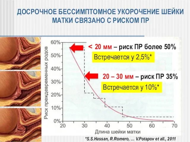 ДОСРОЧНОЕ БЕССИМПТОМНОЕ УКОРОЧЕНИЕ ШЕЙКИ МАТКИ СВЯЗАНО С РИСКОМ ПР ˂