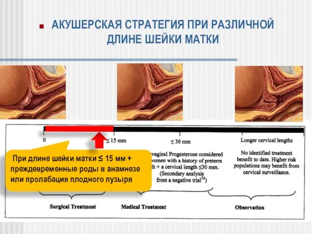 АКУШЕРСКАЯ СТРАТЕГИЯ ПРИ РАЗЛИЧНОЙ ДЛИНЕ ШЕЙКИ МАТКИ При длине шейки