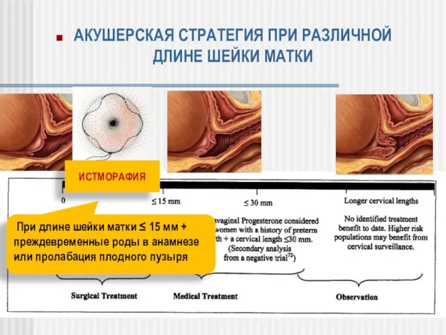 ИСТМОРАФИЯ При длине шейки матки ≤ 15 мм + преждевременные