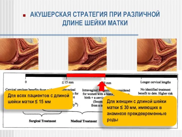 Для всех пациентов с длиной шейки матки ≤ 15 мм