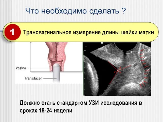 Трансвагинальное измерение длины шейки матки Должно стать стандартом УЗИ исследования