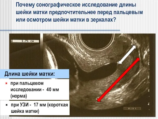 Почему сонографическое исследование длины шейки матки предпочтительнее перед пальцевым или