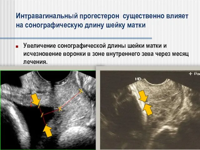Увеличение сонографической длины шейки матки и исчезновение воронки в зоне
