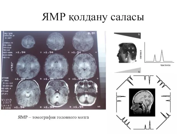 ЯМР қолдану саласы ЯМР – томография головного мозга