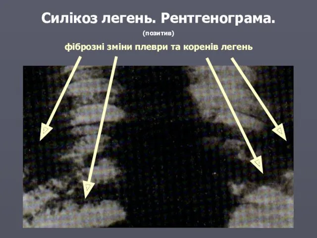 Силікоз легень. Рентгенограма. (позитив) фіброзні зміни плеври та коренів легень