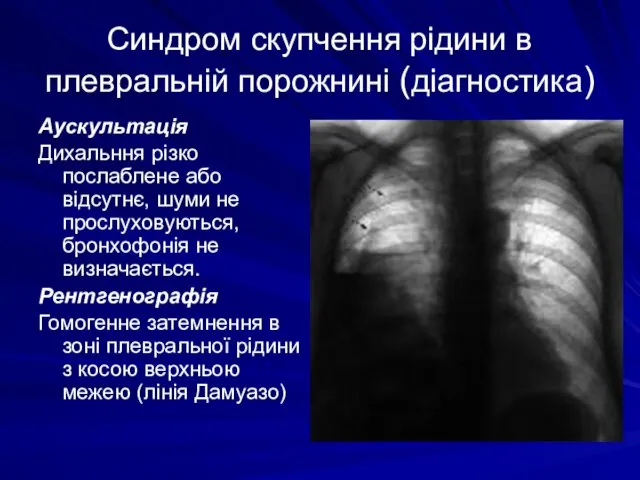Синдром скупчення рідини в плевральній порожнині (діагностика) Аускультація Дихальння різко послаблене або відсутнє,