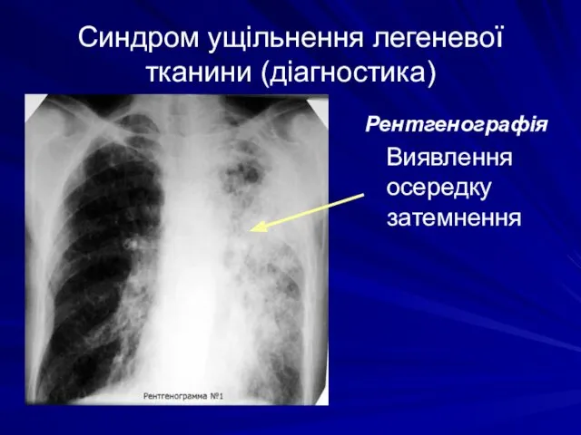 Синдром ущільнення легеневої тканини (діагностика) Рентгенографія Виявлення осередку затемнення