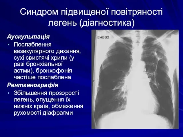 Синдром підвищеної повітряності легень (діагностика) Аускультація Послаблення везикулярного дихання, сухі свистячі хрипи (у
