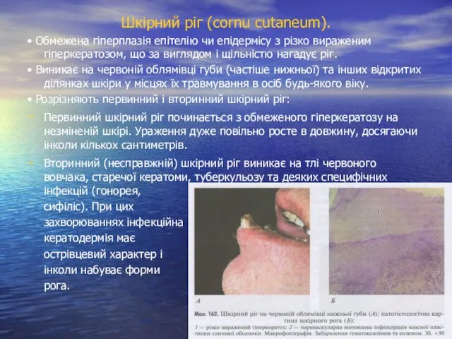 Шкірний ріг (cornu cutaneum). • Обмежена гіперплазія епітелію чи епідермісу
