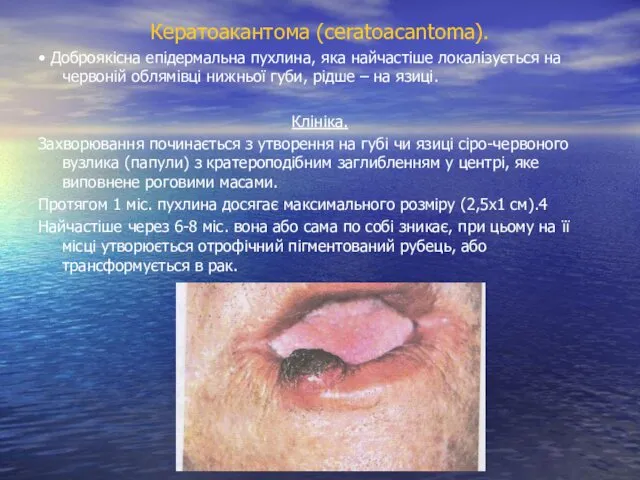 Кератоакантома (ceratoacantoma). • Доброякісна епідермальна пухлина, яка найчастіше локалізується на