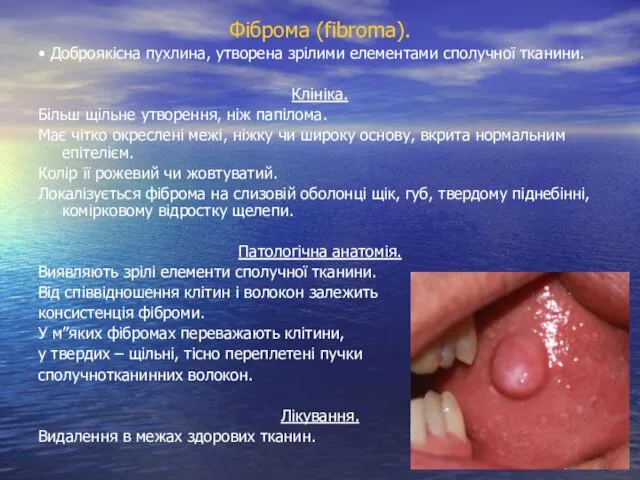 Фіброма (fibroma). • Доброякісна пухлина, утворена зрілими елементами сполучної тканини.