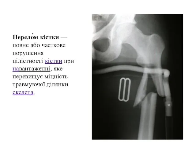 Перело́м кістки — повне або часткове порушення цілістності кістки при навантаженні, яке перевищує