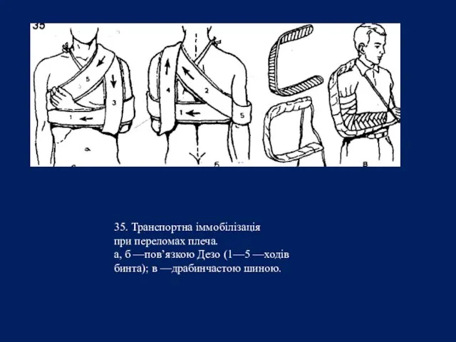 35. Транспортна іммобілізація при переломах плеча. а, б —пов’язкою Дезо (1—5 —ходів бинта); в —драбинчастою шиною.