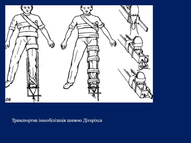 Транспортна іммобілізація шиною Дітеріхса