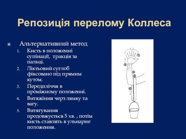 Репозиція перелому Коллеса Альтернативний метод Кисть в положенні супінації, тракція