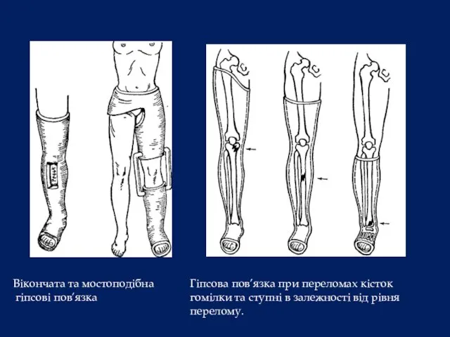Гіпсова пов’язка при переломах кісток гомілки та ступні в залежності від рівня перелому.
