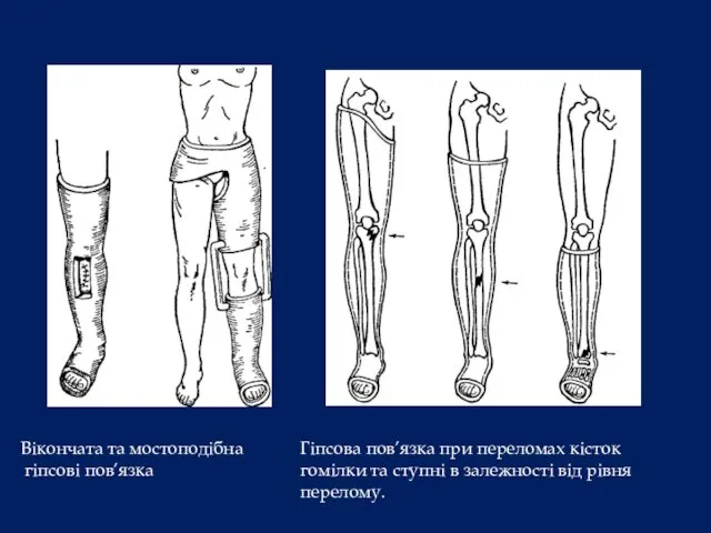Гіпсова пов’язка при переломах кісток гомілки та ступні в залежності
