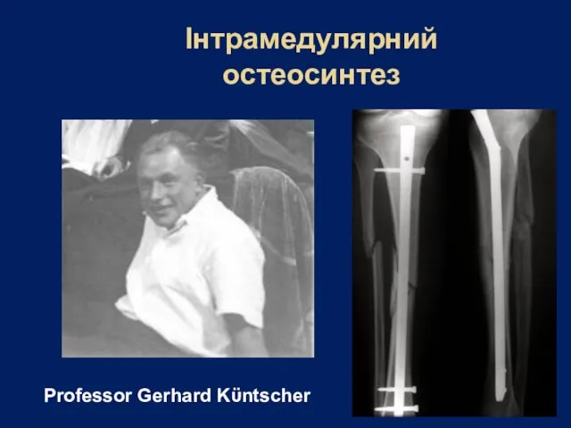 Інтрамедулярний остеосинтез Professor Gerhard Kϋntscher