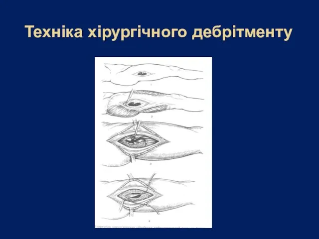 Техніка хірургічного дебрітменту