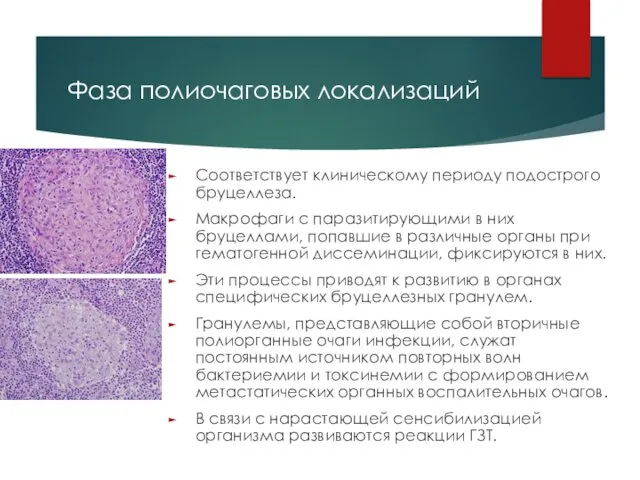 Фаза полиочаговых локализаций Соответствует клиническому периоду подострого бруцеллеза. Макрофаги с