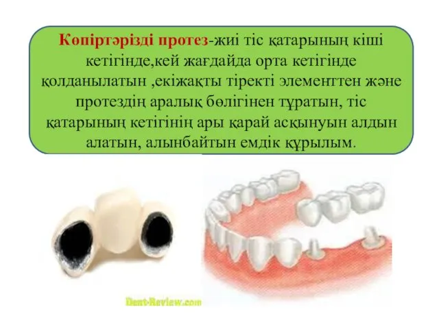 Көпіртәрізді протез-жиі тіс қатарының кіші кетігінде,кей жағдайда орта кетігінде қолданылатын