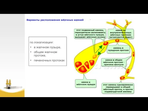 по локализации: в желчном пузыре, общем желчном протоке, печеночных протоках