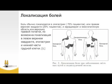 Локализация болей Боль обычно локализуется в эпигастрии ( 70% пациентов),