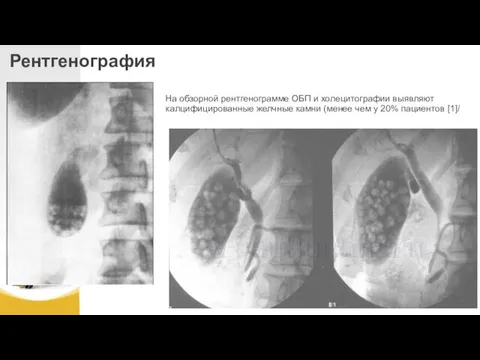 Рентгенография На обзорной рентгенограмме ОБП и холецитографии выявляют калцифицированные желчные