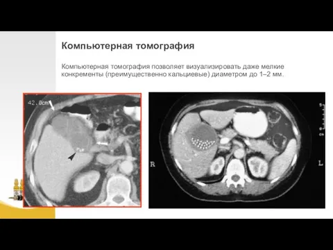 Компьютерная томография Компьютерная томография позволяет визуализировать даже мелкие конкременты (преимущественно кальциевые) диаметром до 1–2 мм.