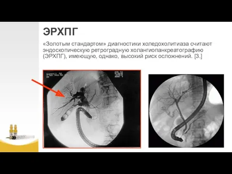 ЭРХПГ «Золотым стандартом» диагностики холедохолитиаза считают эндоскопическую ретроградную холангиопанкреатографию (ЭРХПГ), имеющую, однако, высокий риск осложнений. [3.]